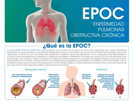 Todo lo que necesitas saber de la EPOC
