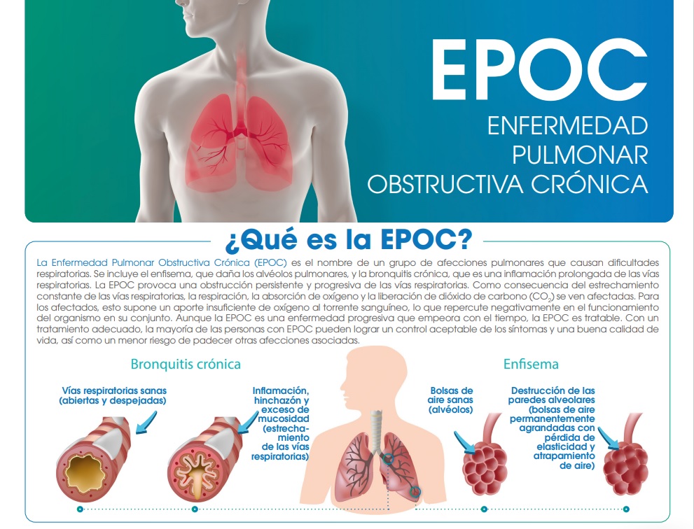 Todo lo que necesitas saber de la EPOC